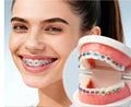 artificial teeth with fixed metal braces.